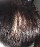 後頭部の薄毛（改善前）