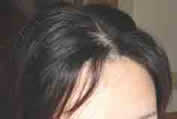 前頭部の薄毛（改善途中）