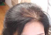 女性の薄毛（前頭部）